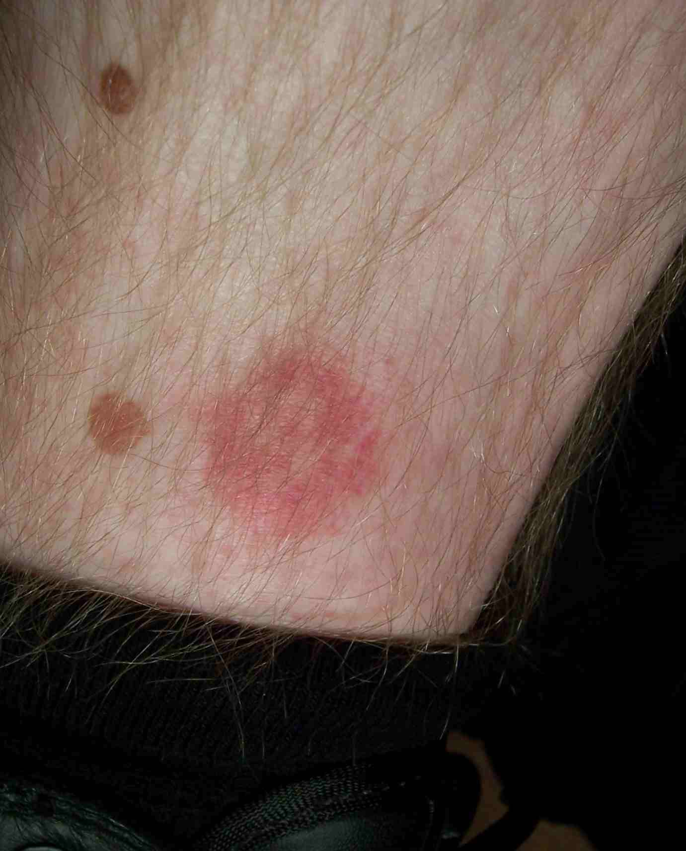 picture of lyme disease bite #11